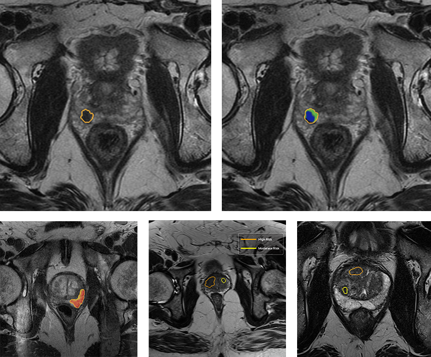 qp-prostate-analysis